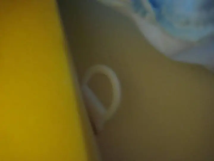 Incorrect use of Velcro straps